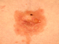 Herpes gestationis (pemphigoid gestationis)
