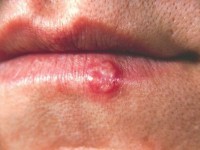 Herpes simplex labialis