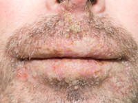 Stomatitis herpetica