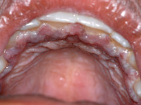 Stomatitis herpetica