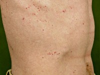 Herpes simplex disseminata