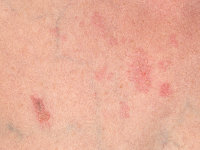 Herpes simplex disseminata