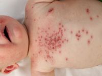 Herpes simplex neonatorum