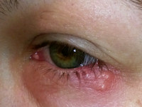 Herpes simplex eyelid
