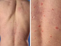 Gegeneraliseerde herpes zoster infectie