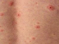 Gegeneraliseerde herpes zoster infectie