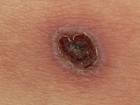 Gegeneraliseerde herpes zoster infectie