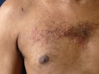 Shingles (herpes zoster)