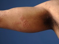 Gordelroos (herpes zoster)