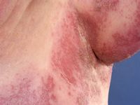 Shingles (herpes zoster)