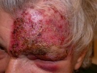 Shingles face ophthalmic nerve