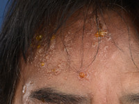 Shingles face ophthalmic nerve