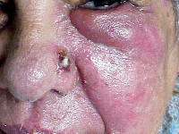 Gordelroos gelaat nervus maxillaris