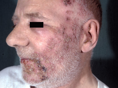 Gordelroos gelaat nervus ophthalmicus