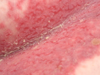 Hailey-Hailey disease (pemphigus benign familiaris chronicus)