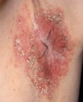 Hailey-Hailey disease (pemphigus benign familiaris chronicus)
