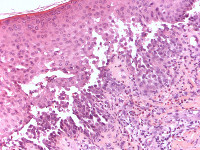 Histologie Hailey-Hailey disease