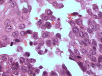 Histologie Hailey-Hailey disease