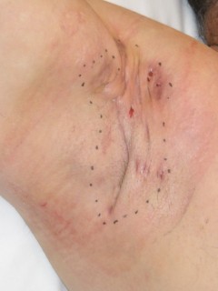 Surgery of the fistula area in hidradenitis suppurativa