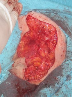Surgery of the fistula area in hidradenitis suppurativa
