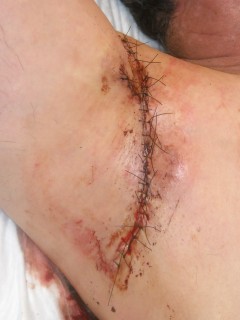 Surgery of the fistula area in hidradenitis suppurativa