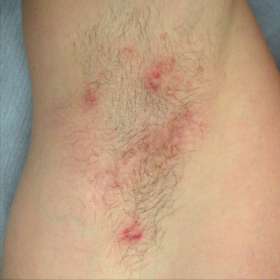 Hurley classificatie hidradenitis suppurativa