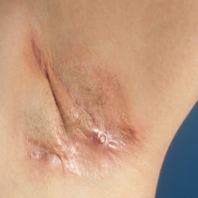 Hurley classificatie hidradenitis suppurativa
