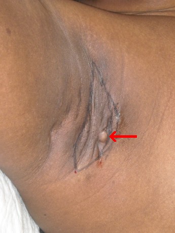Armpit fistula in hidradenitis suppurativa