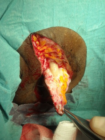 Armpit fistula in hidradenitis suppurativa