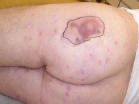 Fistula on the buttock