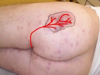 Fistula on the buttock