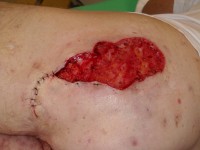 Fistula on the buttock