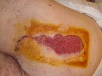 Fistula on the buttock