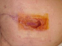 Fistula on the buttock