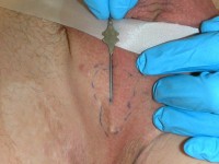 Fistula on the buttock in hidradenitis suppurativa