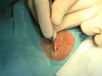 Fistulas on the buttock in hidradenitis suppurativa