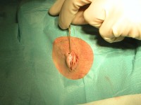 Fistulas on the buttock in hidradenitis suppurativa