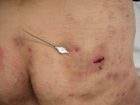 Fistula on the buttock in hidradenitis suppurativa