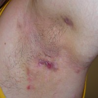 Hidradenitis suppurativa (Hurley I)