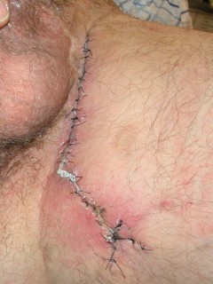 Surgery (resection) of fistulas and abscesses in hidradenitis suppurativa