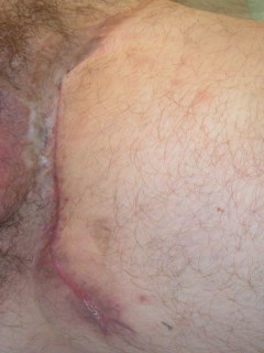 Surgery (resection) of fistulas and abscesses in hidradenitis suppurativa