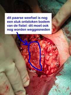 Surgery (resection) of fistulas and abscesses in hidradenitis suppurativa