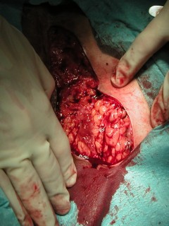 Surgery (resection) of fistulas and abscesses in hidradenitis suppurativa