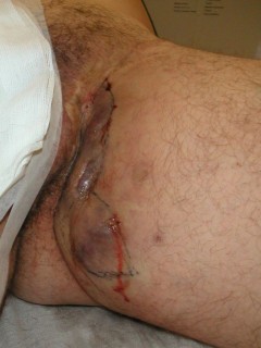 Surgery (resection) of fistulas and abscesses in hidradenitis suppurativa