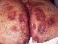 Hidradenitis suppurativa of the buttocks, a severe variant with purple inflammation around it. This form is well-suited for treatment with biologicals (Remicade, Humira). Surgical intervention is not feasible due to the extensive spread.