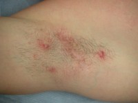 Hidradenitis suppurativa of the armpit, mild variant