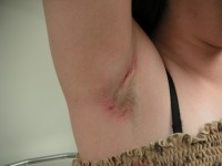 Hidradenitis suppurativa of the armpit, mild variant