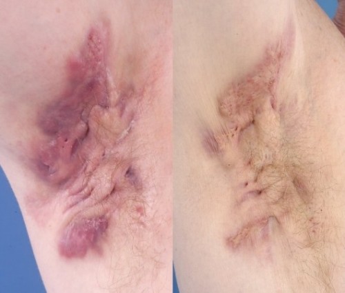 Hidradenitis suppurativa of the axillae after treatment with infliximab