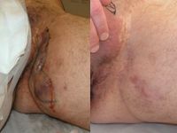 Hidradenitis suppurativa before and after excision
