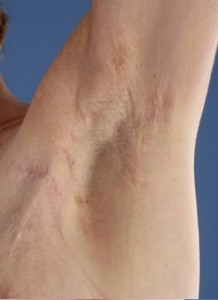 Hidradenitis suppurativa of the axillae after treatment with infliximab